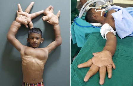 Огромную руку уменьшили мальчику из Индии
