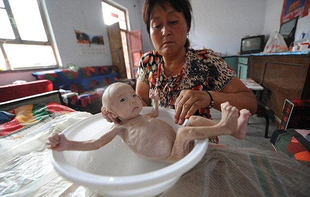 В Китае родился мальчик с редкой аномалией прямой кишки