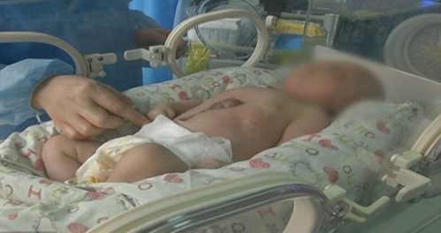Ребенок с сердцем вне тела родился в Китае