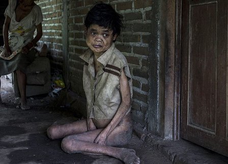 Ужасная жизнь душевнобольных в индонезийской деревне