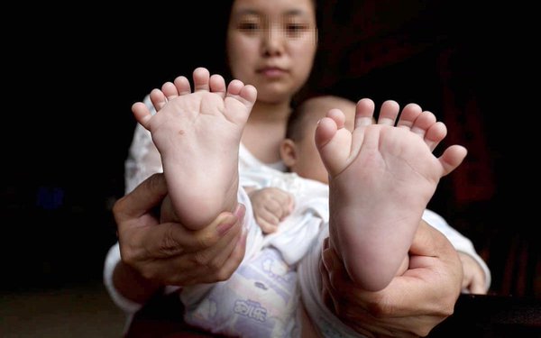 В Китае родился мальчик с 15-тью пальцами на руках и 16-тью на ногах