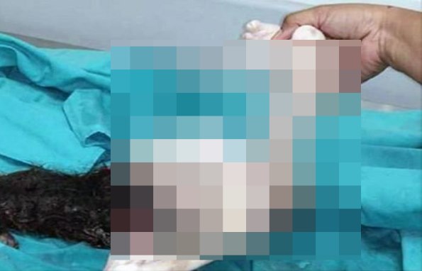 Внутри 15-летнего подростка найден его брат-паразит с головой, ногами и гениталиями