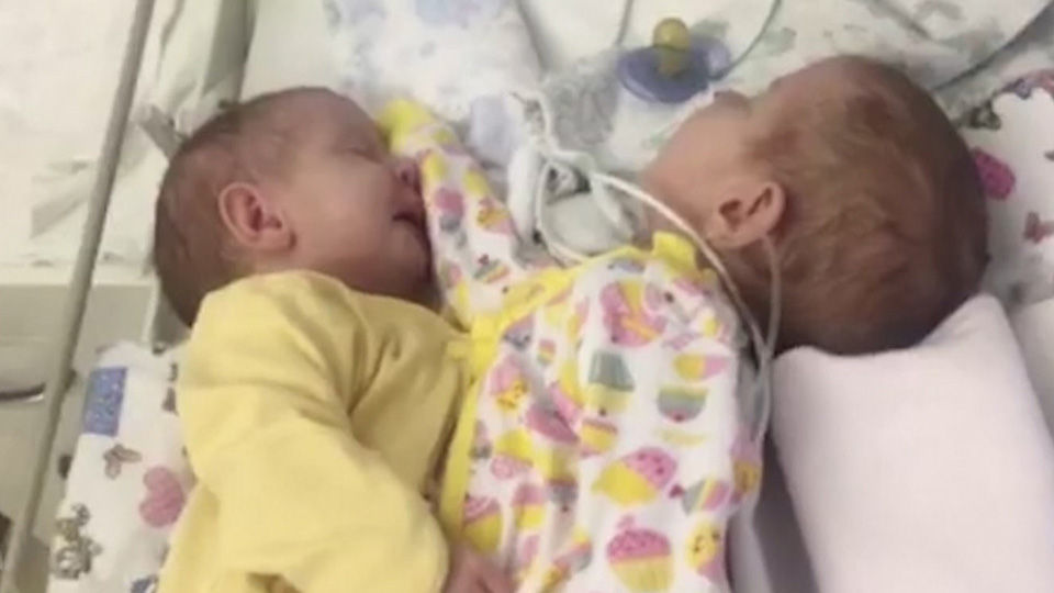Жительница Новосибирска родила сиамских близнецов. Детей готовят к операции