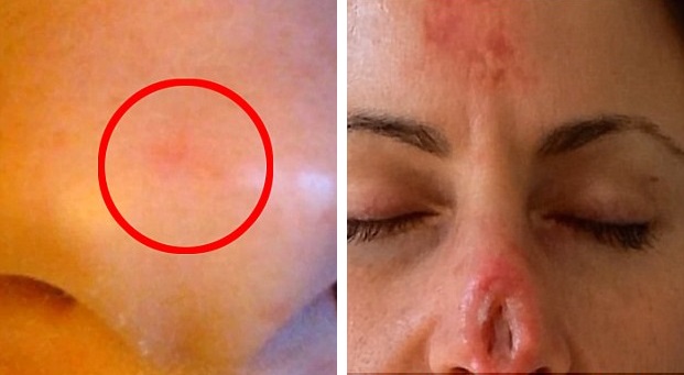 Женщина лечила рак кожи народной медициной и получила большую дыру в носу