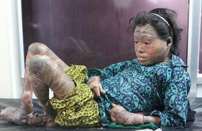 13-летняя девочка из Непала страдает от сильного ихтиоза