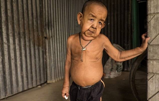 Четырехлетний мальчик из Бангладеш выглядит как старик