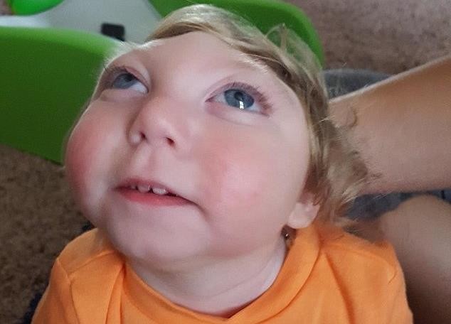 Мальчику без мозга исполнилось два года