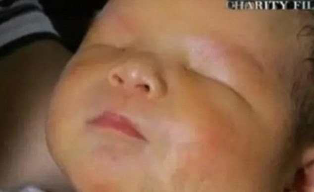 В Китае родился мальчик без глаз