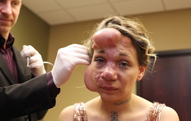 Девушке вшили под кожу лица шары, чтобы скрыть шрамы после удаления патологии