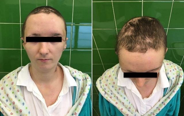 Читать В Польше прооперировали девушку, которой сорвало часть скальпа