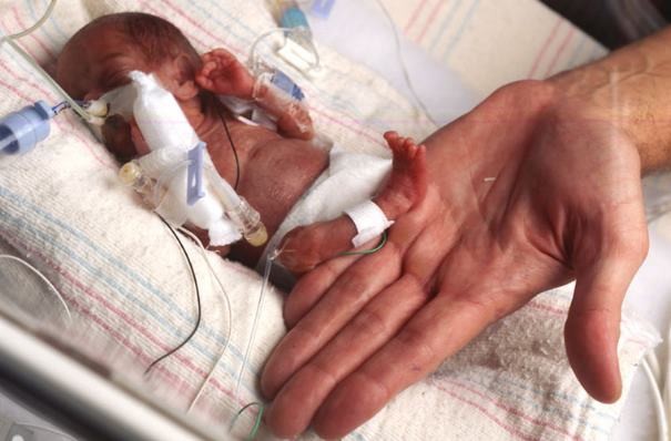Эмилия, самый крошечный выживший младенец в мире