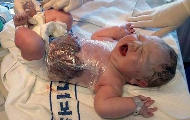 Мальчика, родившегося с кишечником вне тела, успешно прооперировали в Ирландии