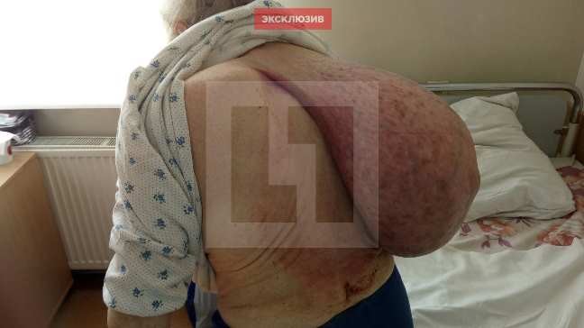 Врачи Калининграда избавили пенсионерку от опухоли на шее весом в 10 кг