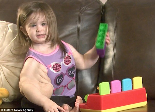 Девочка с редкой генетической мутацией, которая увеличила объем ее рук в несколько раз