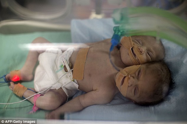 Двухголовый ребенок родился в Палестине