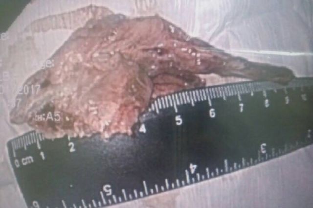 Психически больной житель Красноярского края проглотил целиком сырой куриный окорочок
