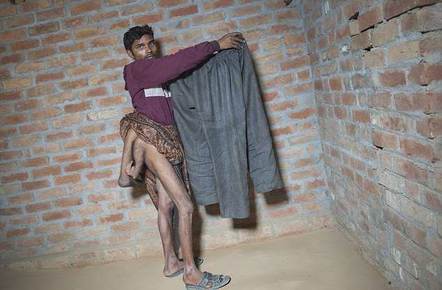 22-летний индийский парень хочет удалить две лишние ноги, растущие из его спины