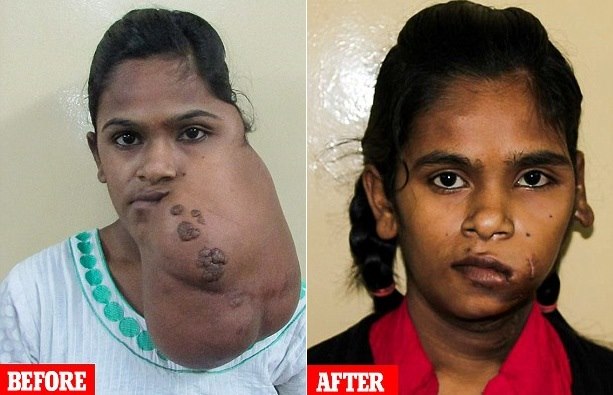 Врачи вернули индийской девушке лицо, удалив гигантскую опухоль