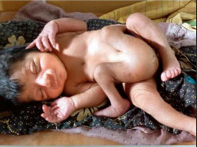 В Индии родился мальчик с четырьмя ногами и двойным набором гениталий