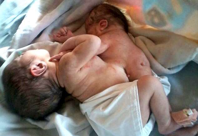 Мальчик родился с растущей из его живота половиной своего брата-близнеца