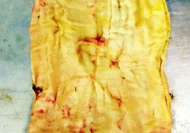 В Индии пациент скончался из-за забытой в нем при операции куске марли