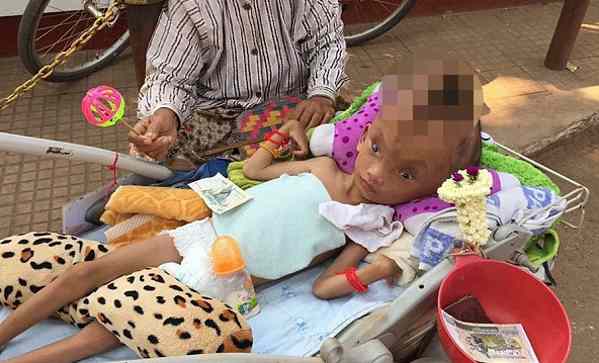 В Камбодже нашли 6-летнего ребенка с черепом, треснувшим как орех