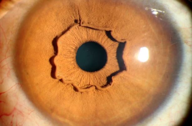 Китаянка удивила офтальмологов необычными глазами