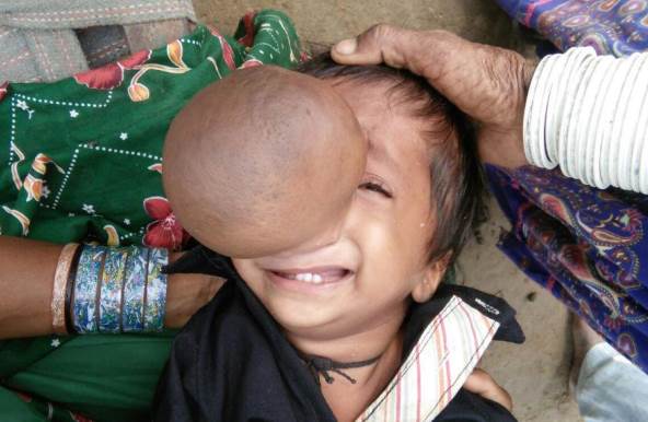 Пакистанский мальчик не может спать из-за огромного носа-опухоли