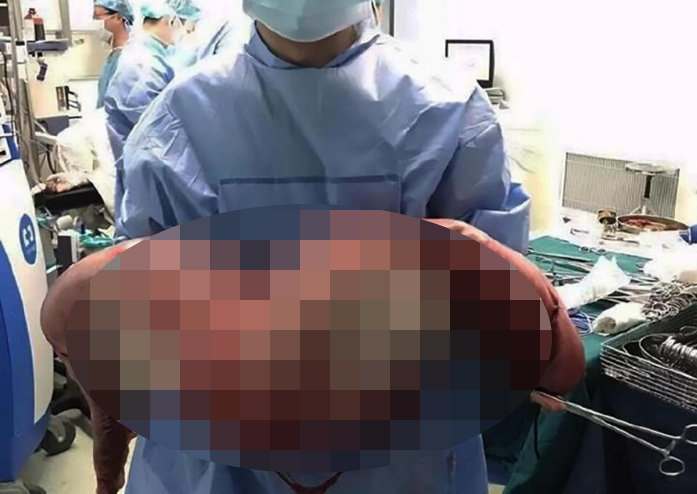 В Шанхае врачи спасли жизнь пациенту, вырезав у него огромный кусок кишки с каловыми массами