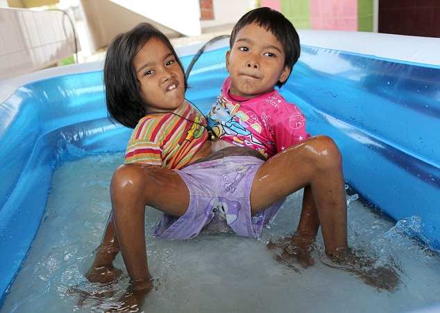 Тайские 7-летние сиамские близнецы с одной на двоих нижней частью тела