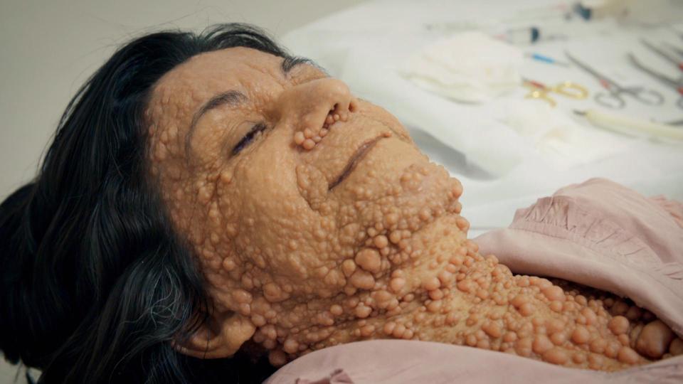 Женщина со множеством пузырьков-опухолей на всем теле
