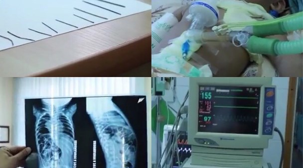 В больнице Ташкента из младенца вытащили 16 игл
