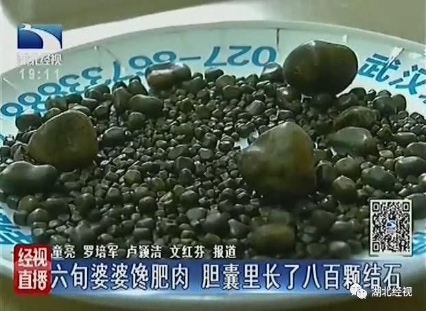 Китайские хирурги извлекли из любительницы поесть жирного мяса 806 желчных камней