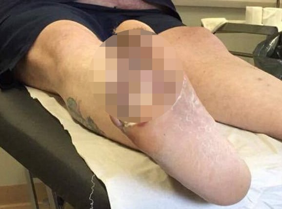 Личинки очистили открытую рану и спасли ногу мужчину от ампутации