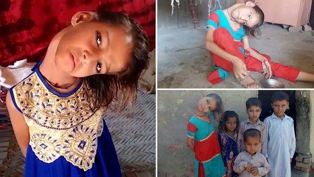 Девочка из Пакистана с кривой шеей живет среди постоянных насмешек