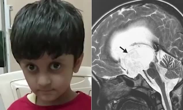 Девочка два года кивала головой из-за врожденной аномалии в мозгу