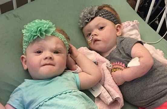 Сросшиеся головами близнецы через полтора года после рисковой операции по разделению