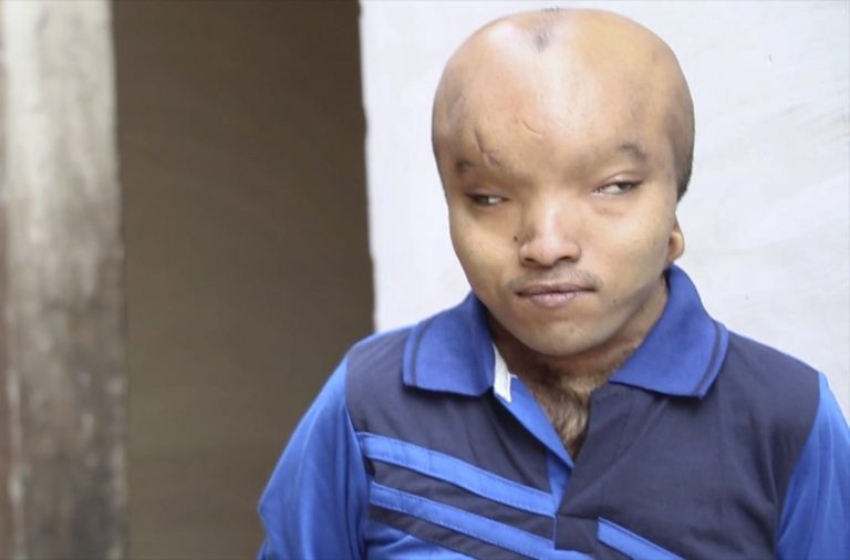 Индийца прозвали Пришельцем из-за необычной аномалии черепа