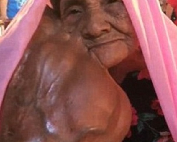 У пожилой женщины выросла на щеке огромная опухоль, но она не хочет делать операцию