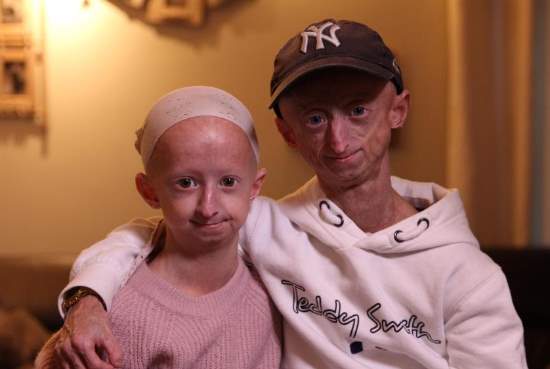 Брат и сестра с прогерией защищают друг друга от жестоких насмешек общества
